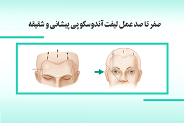 صفر تا صد لیفت آندوسکوپی پیشانی و شقیقه