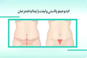 ابدومینوپلاستی و لیفت ژنیتالیا همزمان