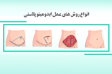 انواع روش های عمل ابدومینوپلاستی